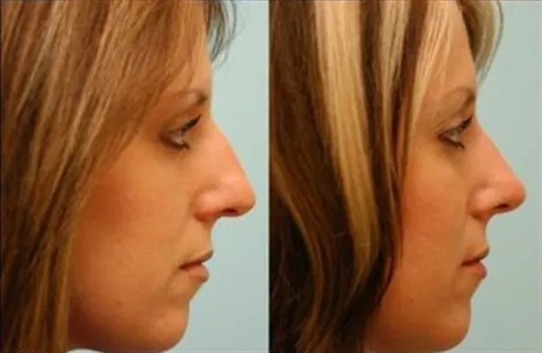 Example of a Greek nose.