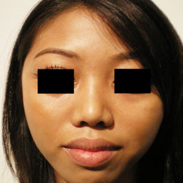 Asian-rhinoplasty